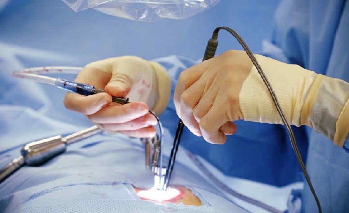 ¿En qué consiste la operación de columna por endoscopia?